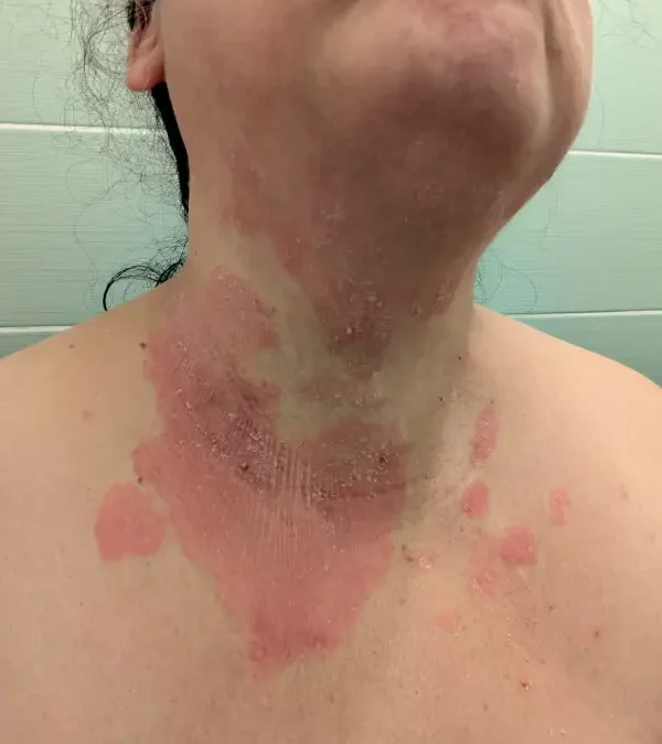 Psoriasis , ce que mon docteur m’a conseillé