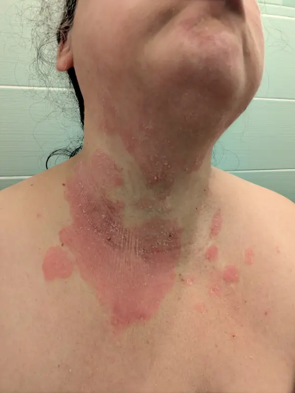 psoriasis